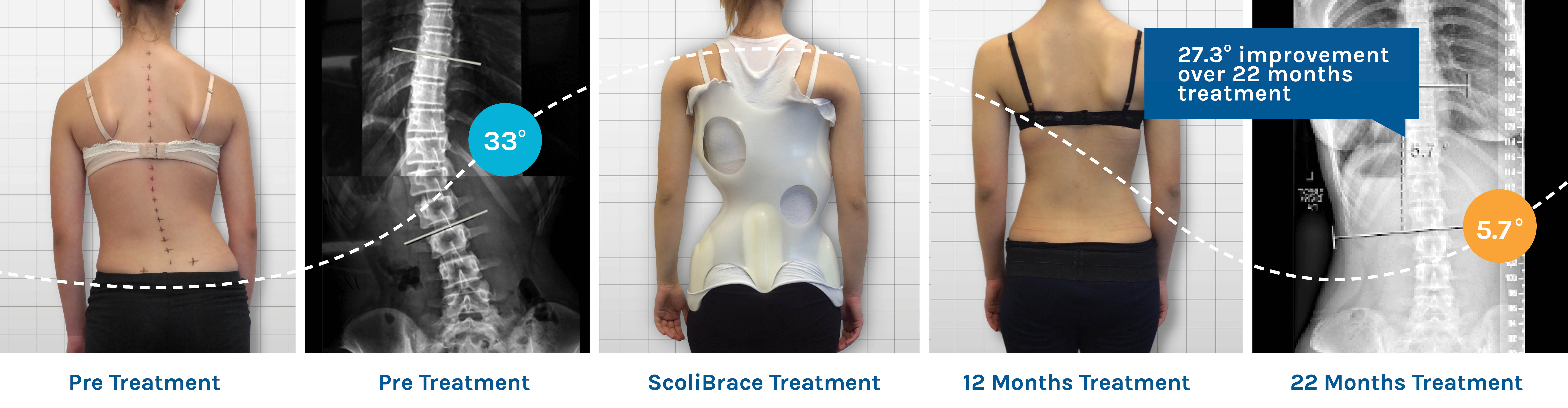 scolibrace-before-after Before and after ScoliBrace treatment showing improved spinal alignment and reduced scoliosis curvature over 22 months.