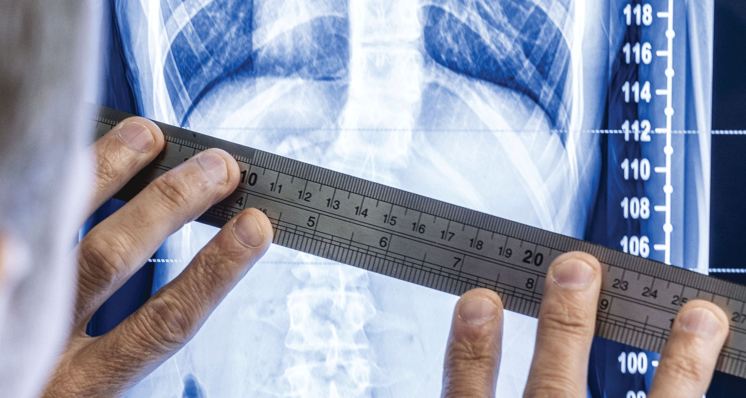 Custom ScoliBrace scoliosis assessment using spinal X-ray measurements to design a personalized 3D corrective brace in Anchorage.