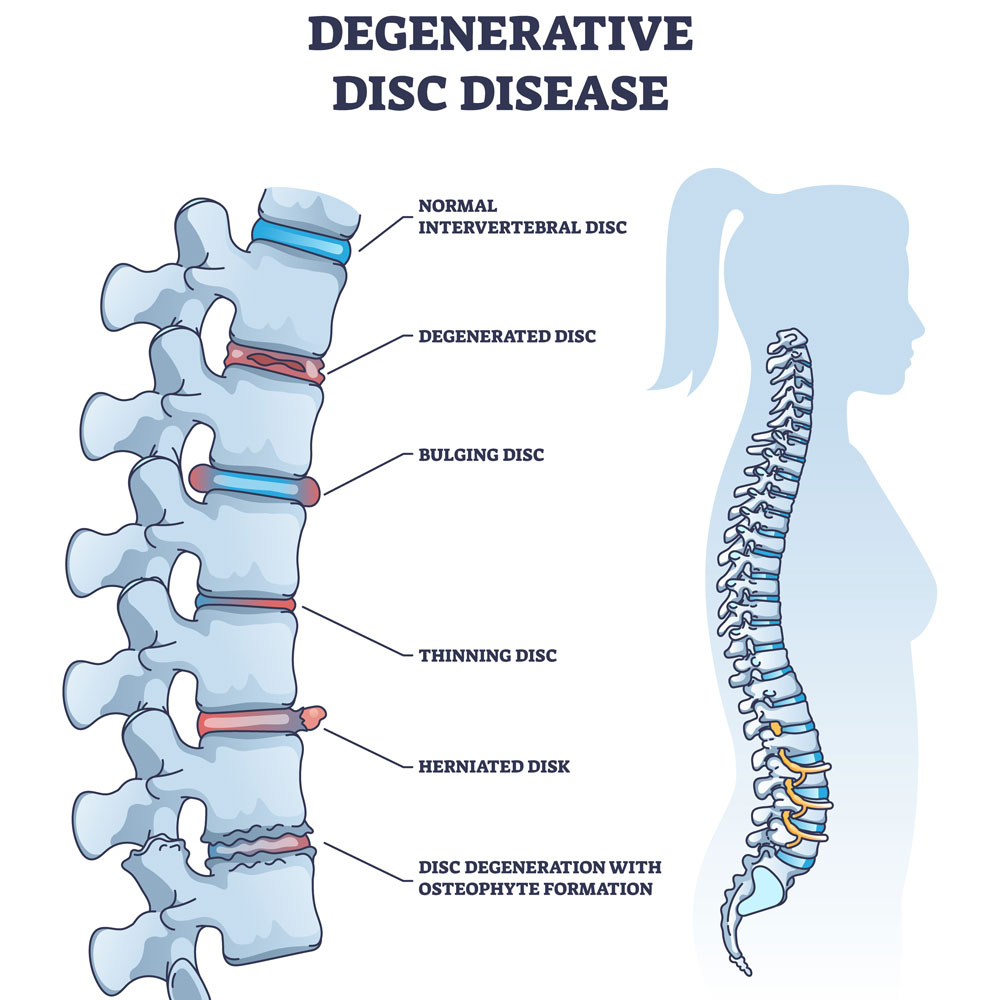 Degenerative Disc Disease, Arthritis, and Herniated Discs