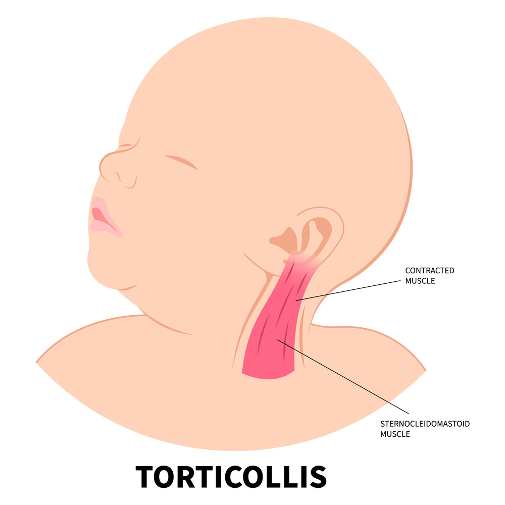 does-your-baby-prefer-looking-one-direction-or-struggle-to-turn-their-head-comfortably Does your baby prefer looking one direction or struggle to turn their head comfortably?