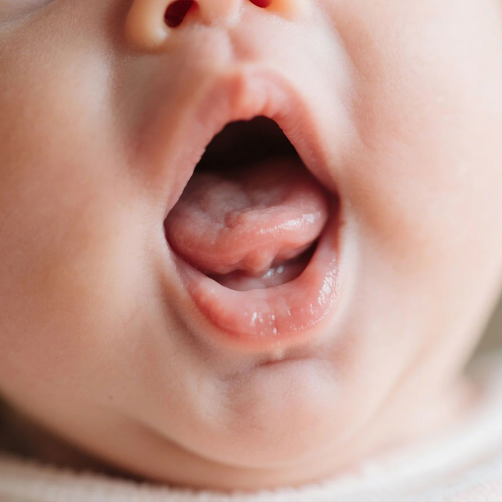 latching-difficulty-tongue-tie-and-torticollis Latching Difficulty, Tongue-Tie, and Torticollis