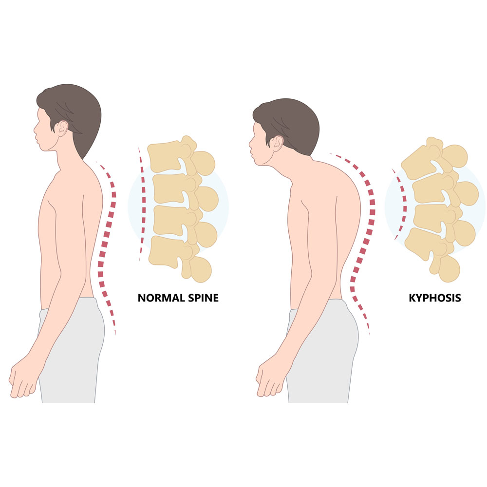 Suffering with kyphosis, a rounded upper back, or worsening posture?