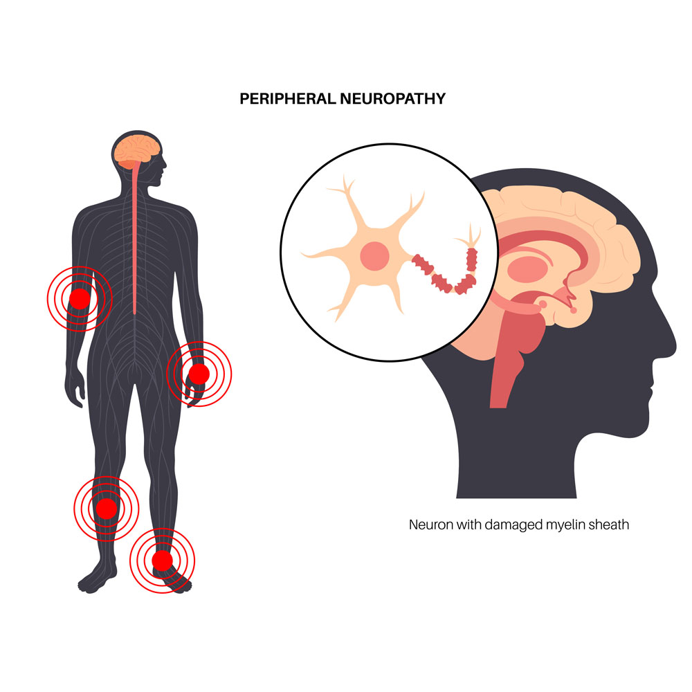 suffering-with-peripheral-neuropathy-numbness-tingling-or-burning-nerve-pain Suffering With Peripheral Neuropathy, Numbness, Tingling, or Burning Nerve Pain?