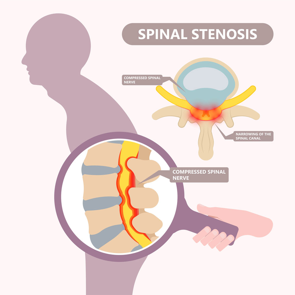 Suffering With Spinal Stenosis, Nerve Pain, or Difficulty Walking?